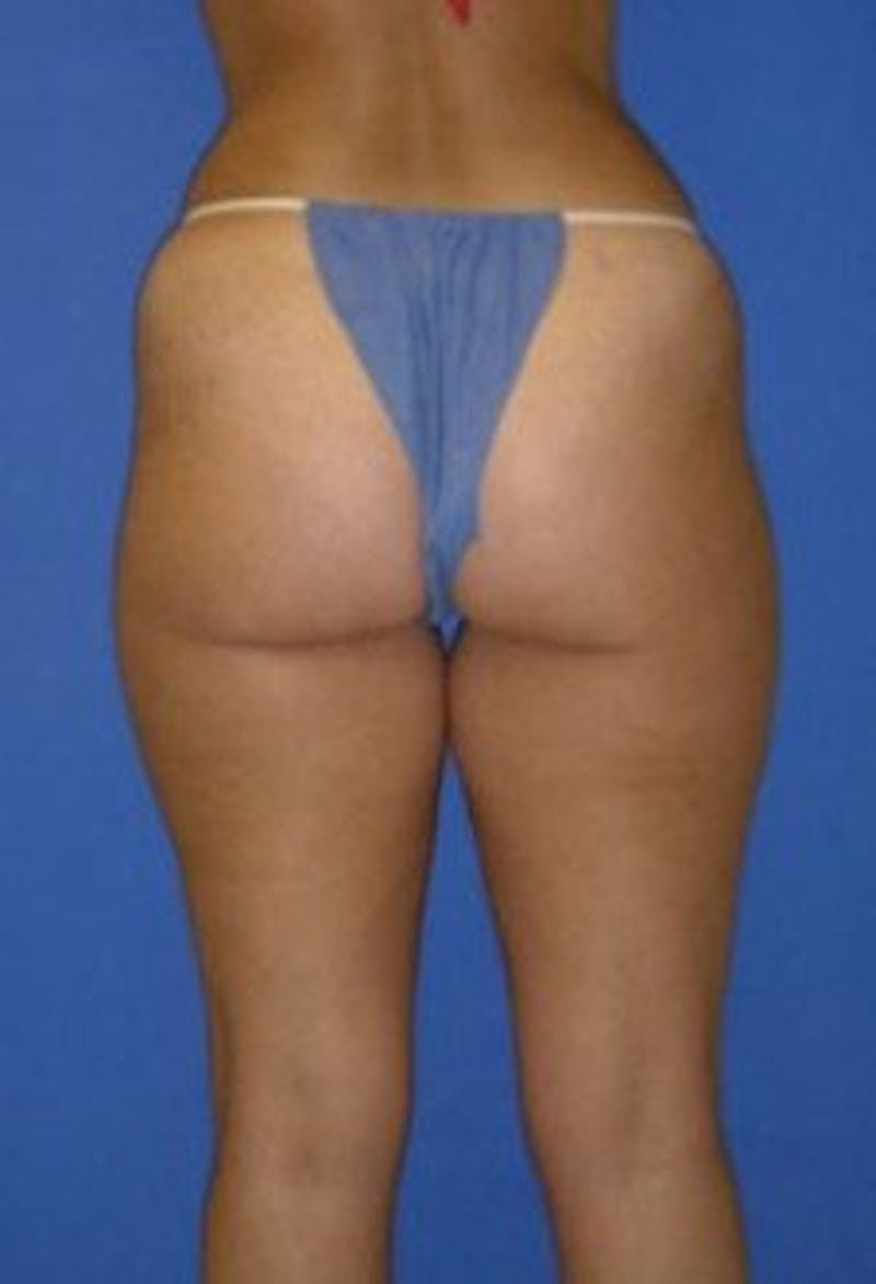 Liposuction Before & After Gallery - Patient 198742 - Image 5