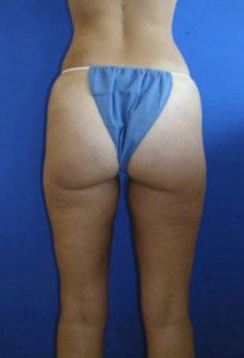 Liposuction Before & After Gallery - Patient 198742 - Image 6