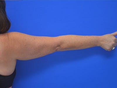 Liposuction Before & After Gallery - Patient 373359 - Image 1