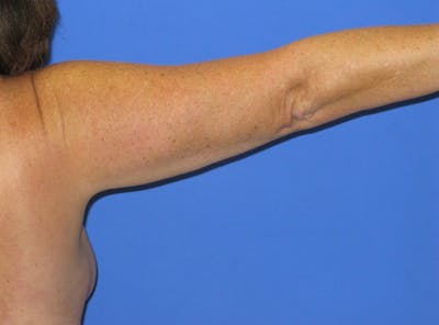 Liposuction Before & After Gallery - Patient 373359 - Image 2