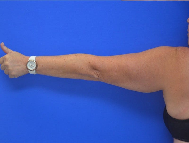Liposuction Before & After Gallery - Patient 373359 - Image 3