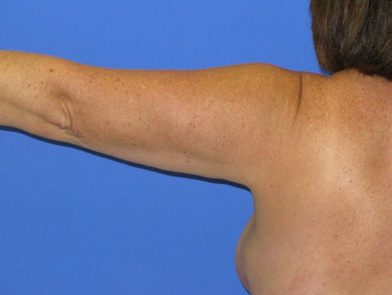 Liposuction Before & After Gallery - Patient 373359 - Image 4