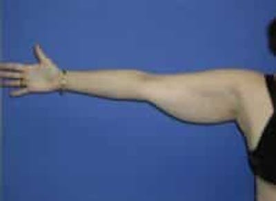 Liposuction Before & After Gallery - Patient 241796 - Image 1