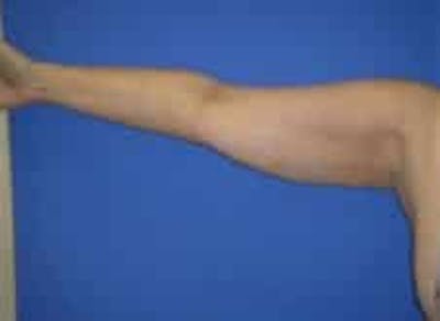Liposuction Before & After Gallery - Patient 241796 - Image 2