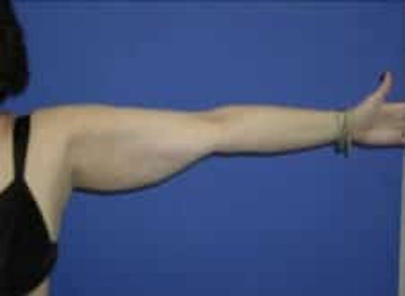 Liposuction Before & After Gallery - Patient 241796 - Image 3