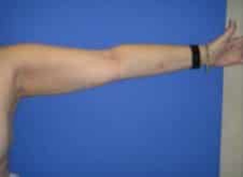Liposuction Before & After Gallery - Patient 241796 - Image 4