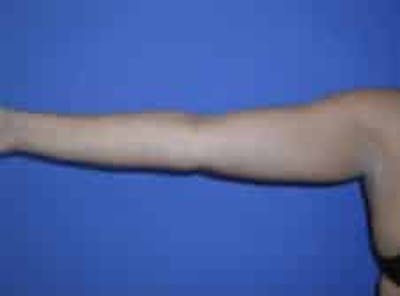 Liposuction Before & After Gallery - Patient 242360 - Image 1