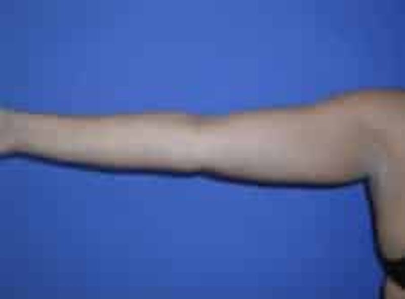 Liposuction Before & After Gallery - Patient 242360 - Image 1