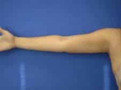 Liposuction Before & After Gallery - Patient 242360 - Image 2