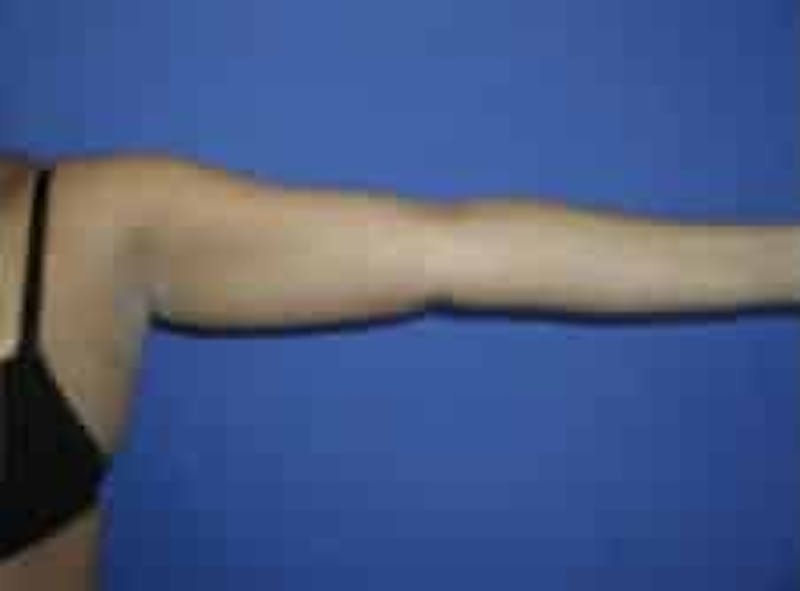 Liposuction Before & After Gallery - Patient 242360 - Image 3