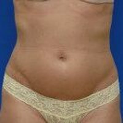 Liposuction Before & After Gallery - Patient 776806 - Image 1