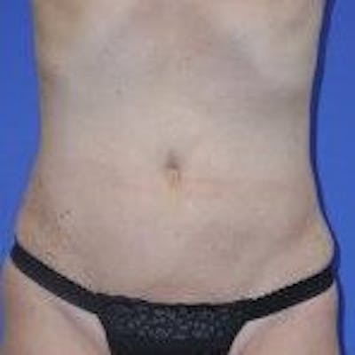 Liposuction Before & After Gallery - Patient 776806 - Image 2