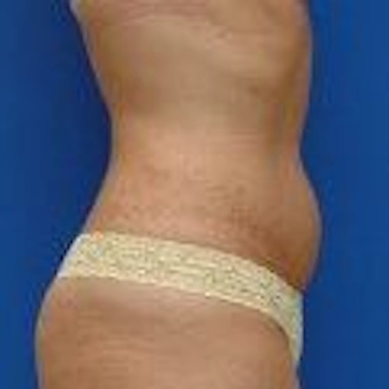 Liposuction Before & After Gallery - Patient 776806 - Image 3