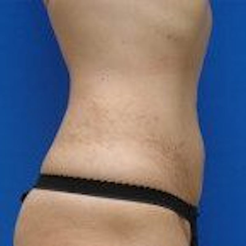 Liposuction Before & After Gallery - Patient 776806 - Image 4
