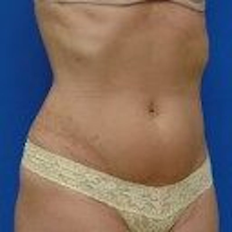 Liposuction Before & After Gallery - Patient 776806 - Image 5