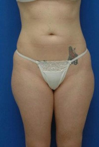 Liposuction Before & After Gallery - Patient 120811 - Image 1