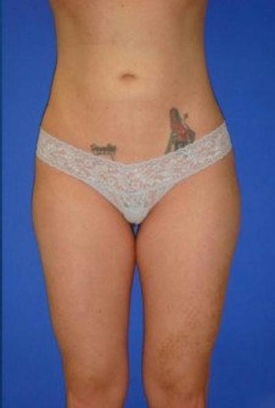 Liposuction Before & After Gallery - Patient 120811 - Image 2