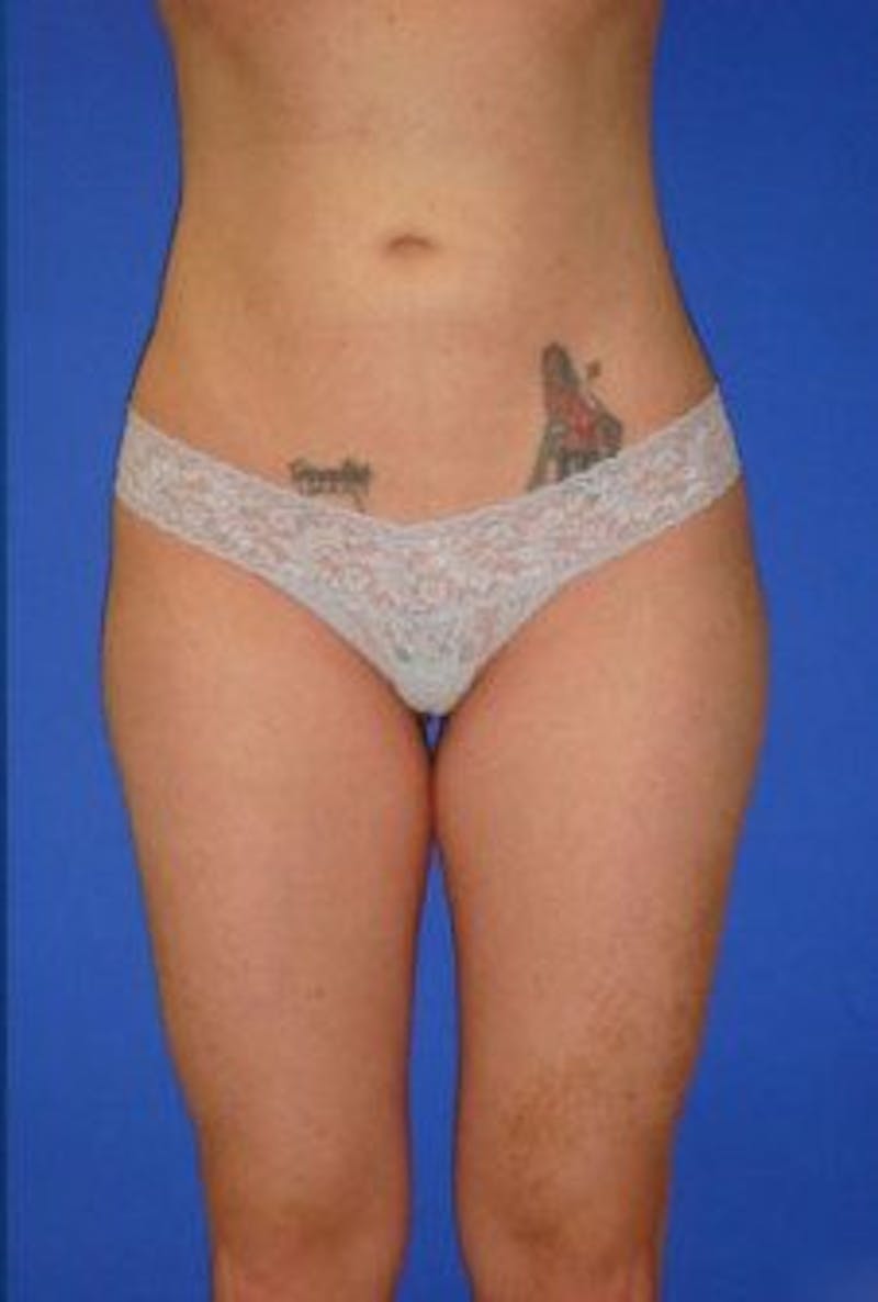 Liposuction Before & After Gallery - Patient 120811 - Image 2