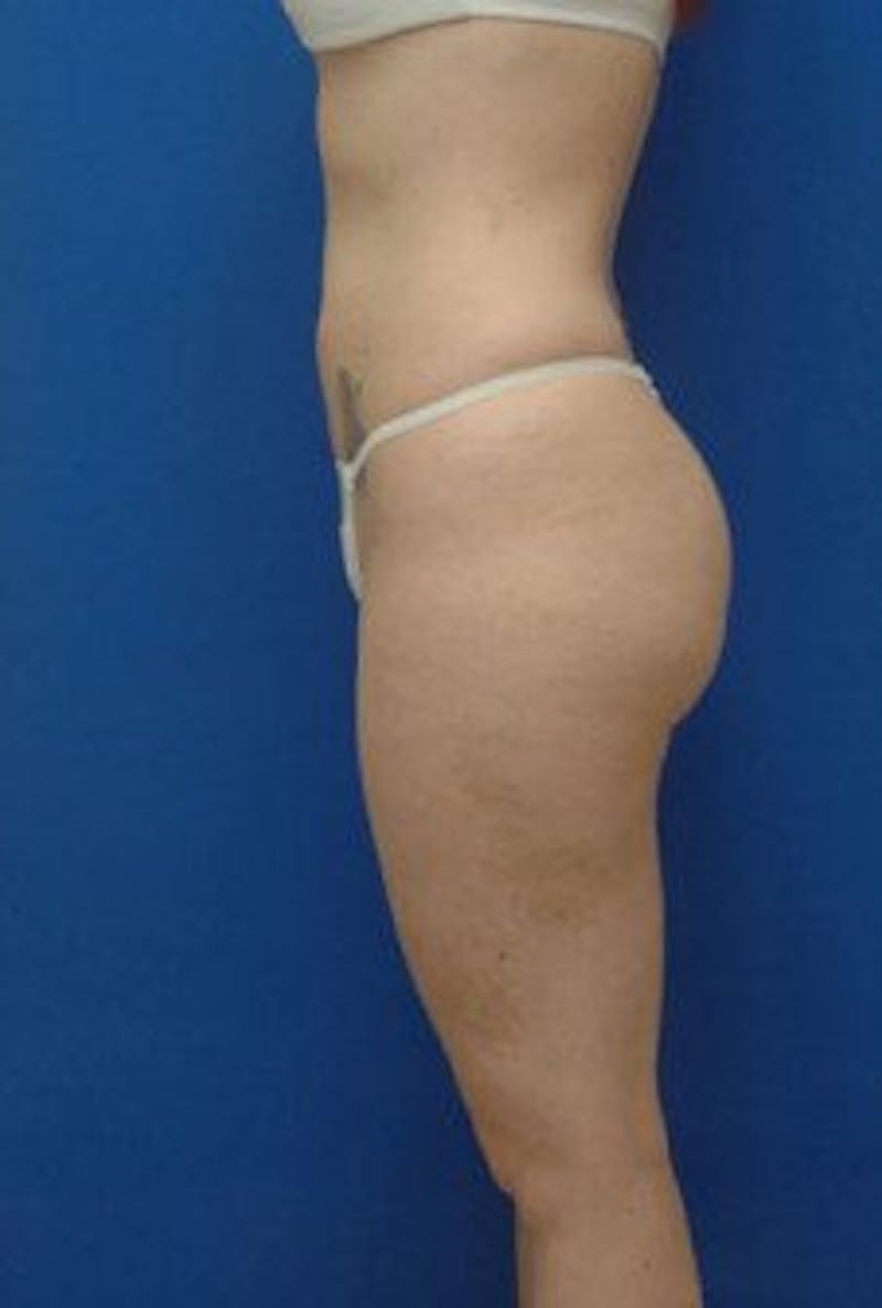 Liposuction Before & After Gallery - Patient 120811 - Image 3