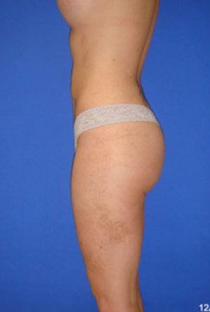 Liposuction Before & After Gallery - Patient 120811 - Image 4