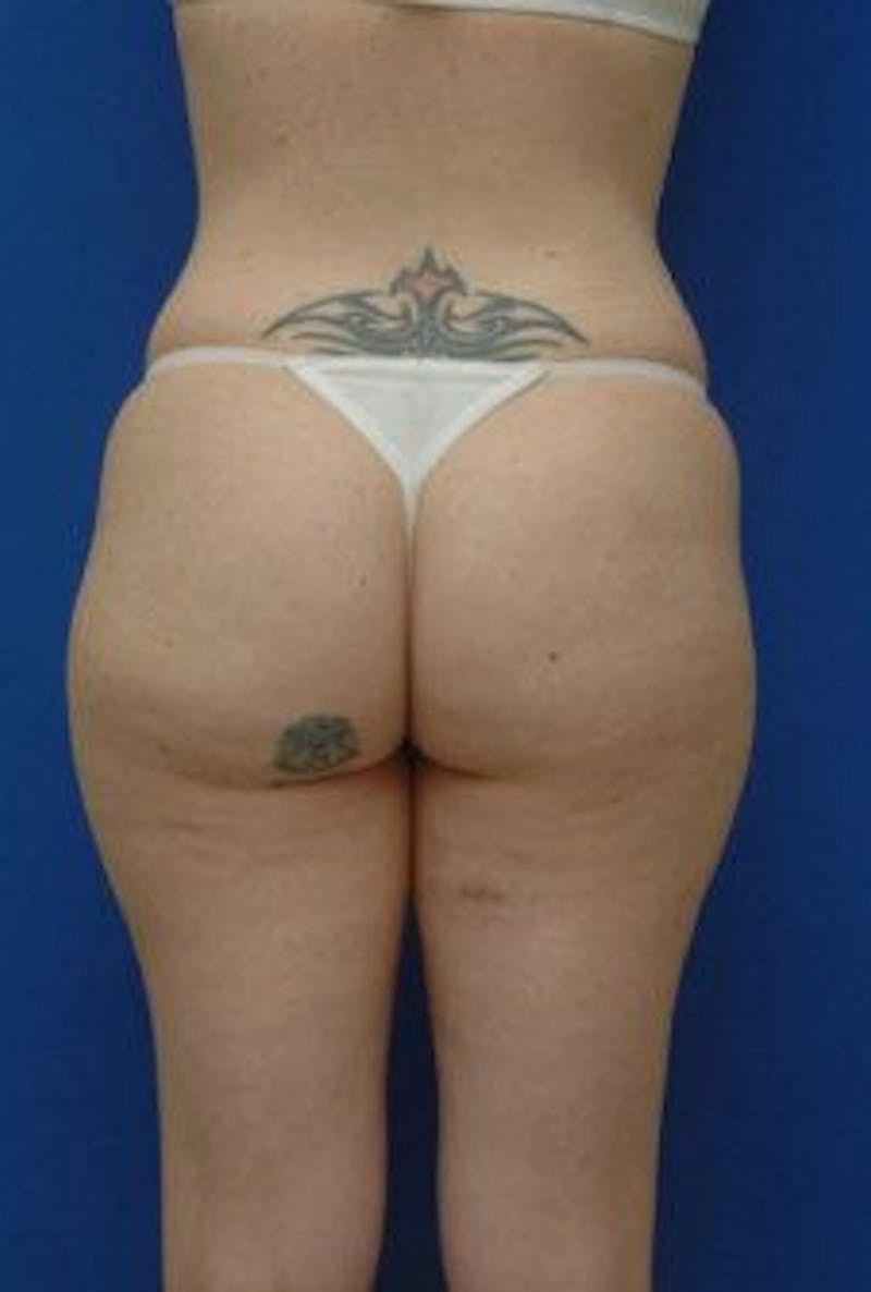 Liposuction Before & After Gallery - Patient 120811 - Image 5