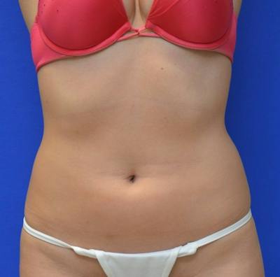 Liposuction Before & After Gallery - Patient 309183 - Image 1