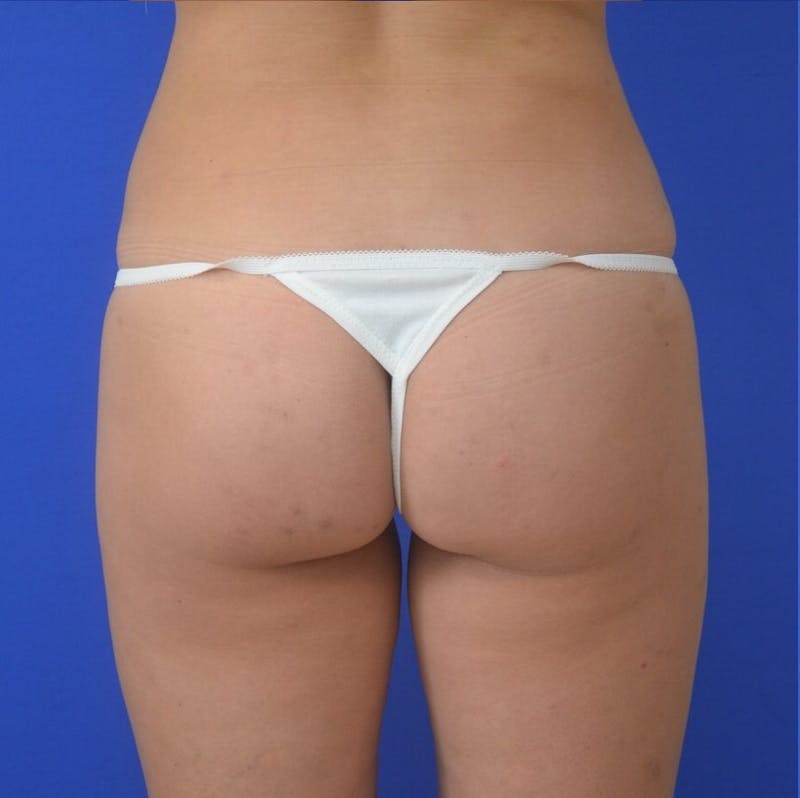 Liposuction Before & After Gallery - Patient 309183 - Image 4