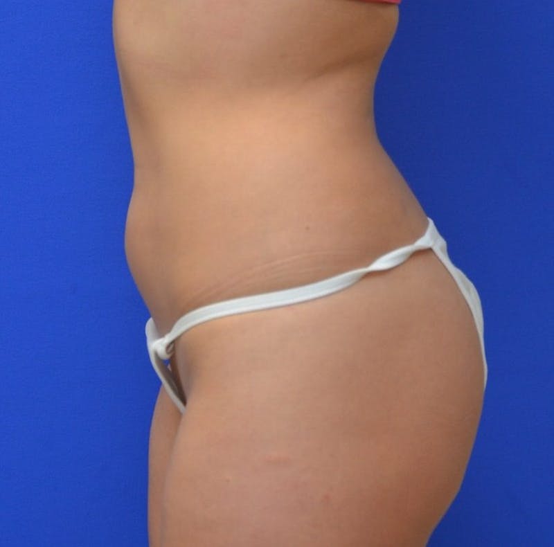 Liposuction Before & After Gallery - Patient 309183 - Image 5