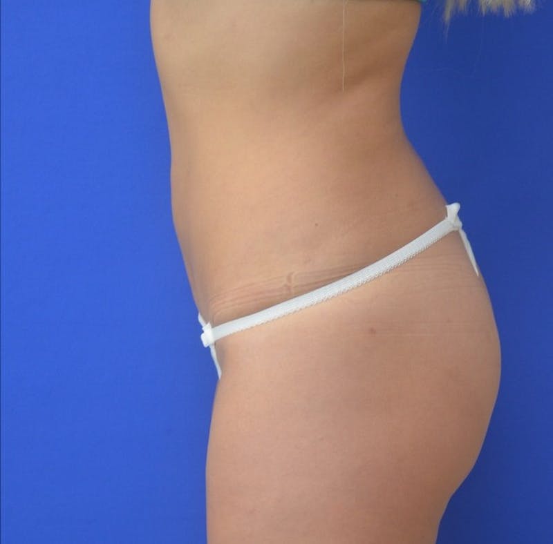 Liposuction Before & After Gallery - Patient 309183 - Image 6