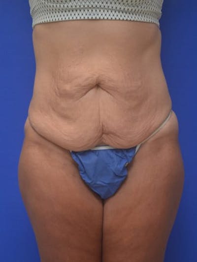 Tummy Tuck Before & After Gallery - Patient 378091 - Image 1