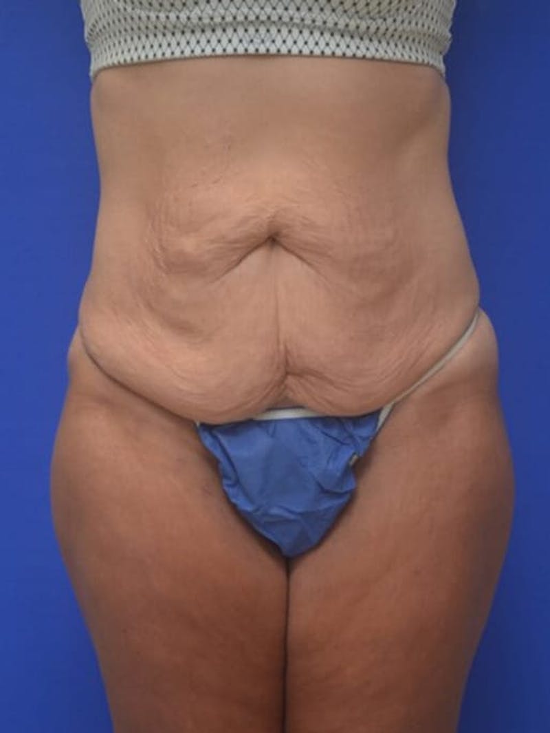 Tummy Tuck Before & After Gallery - Patient 378091 - Image 1