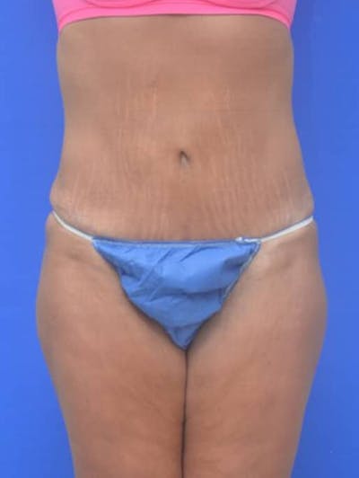 Tummy Tuck Before & After Gallery - Patient 378091 - Image 2