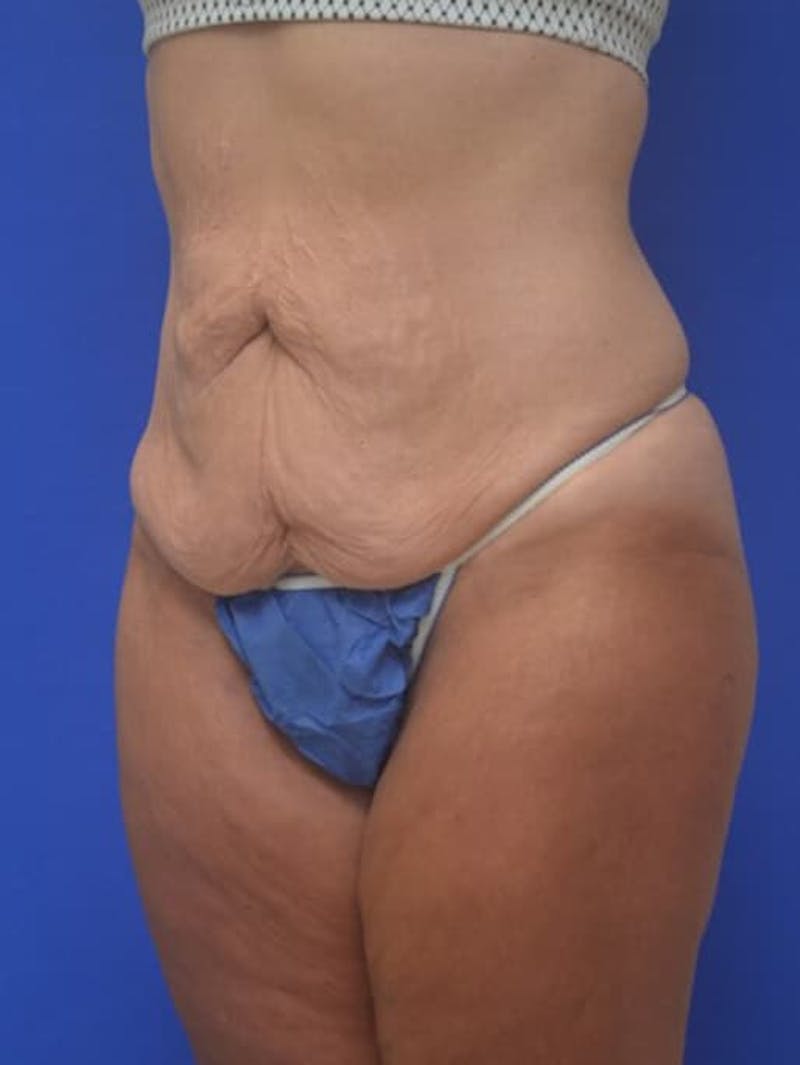 Tummy Tuck Before & After Gallery - Patient 378091 - Image 3