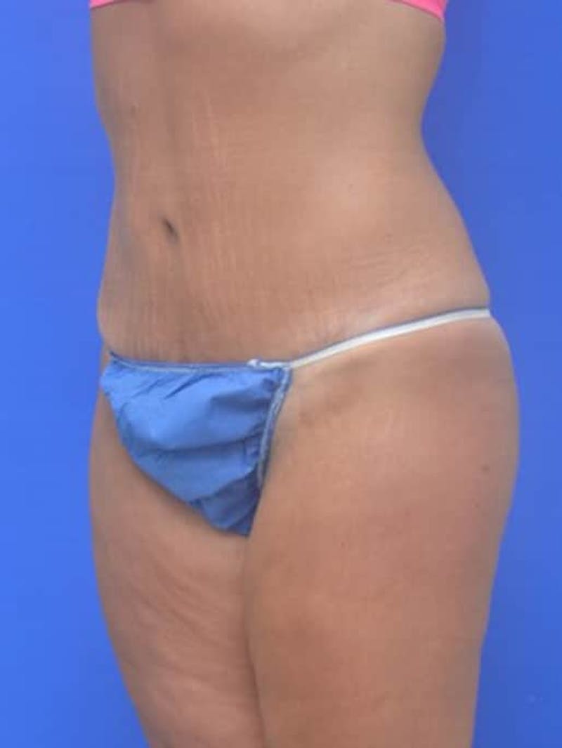 Tummy Tuck Before & After Gallery - Patient 378091 - Image 4