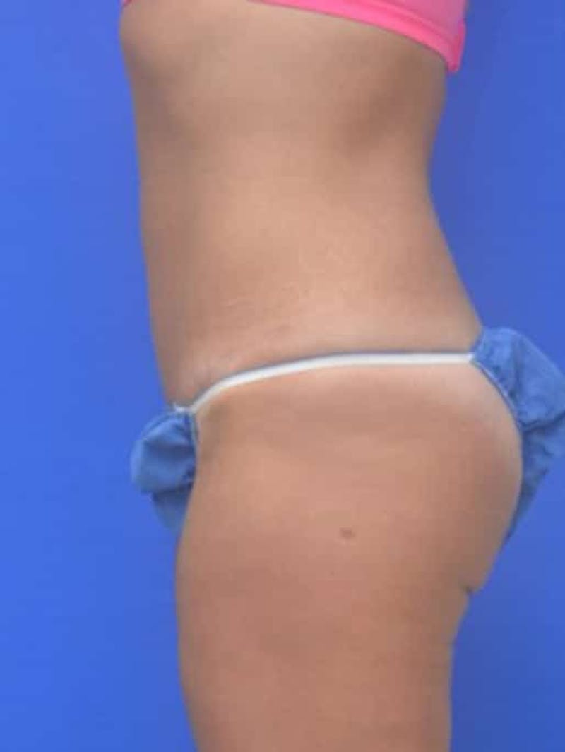Tummy Tuck Before & After Gallery - Patient 378091 - Image 6