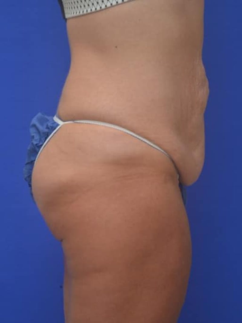 Tummy Tuck Before & After Gallery - Patient 378091 - Image 7