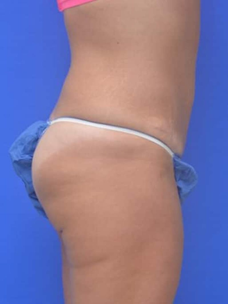 Tummy Tuck Before & After Gallery - Patient 378091 - Image 8