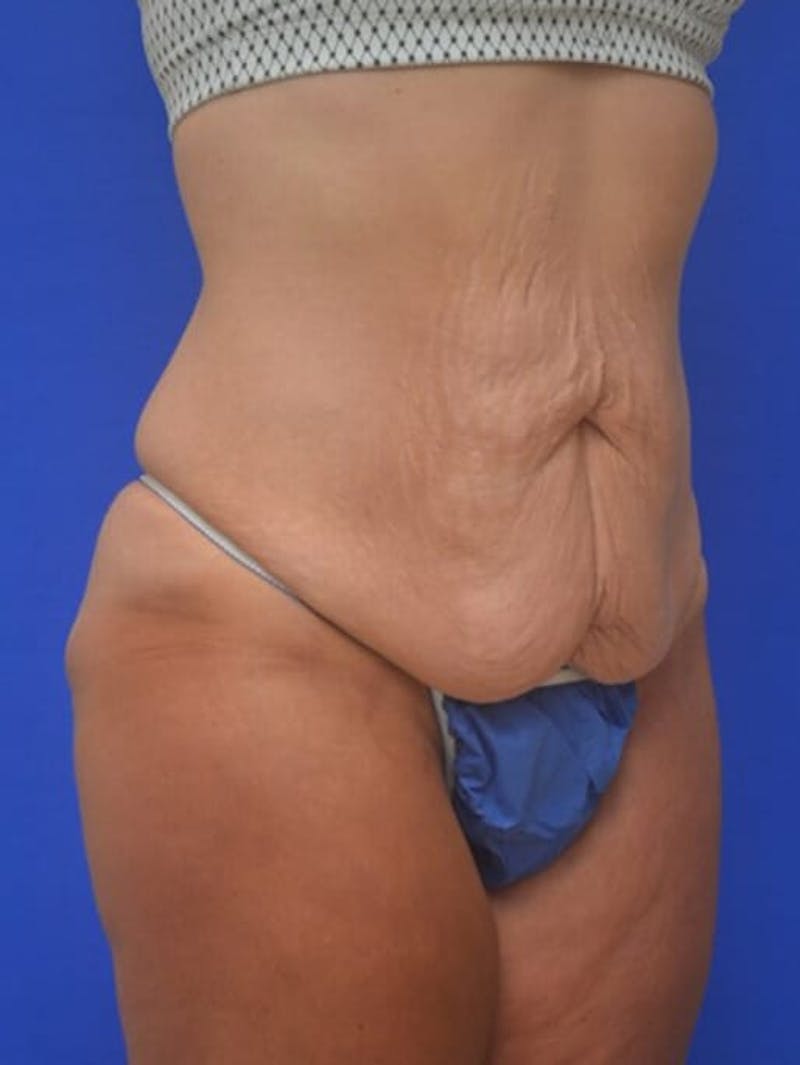 Tummy Tuck Before & After Gallery - Patient 378091 - Image 9