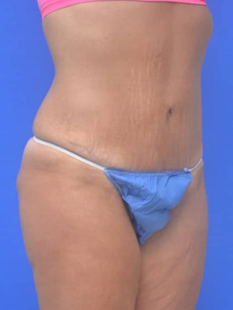 Tummy Tuck Before & After Gallery - Patient 378091 - Image 10