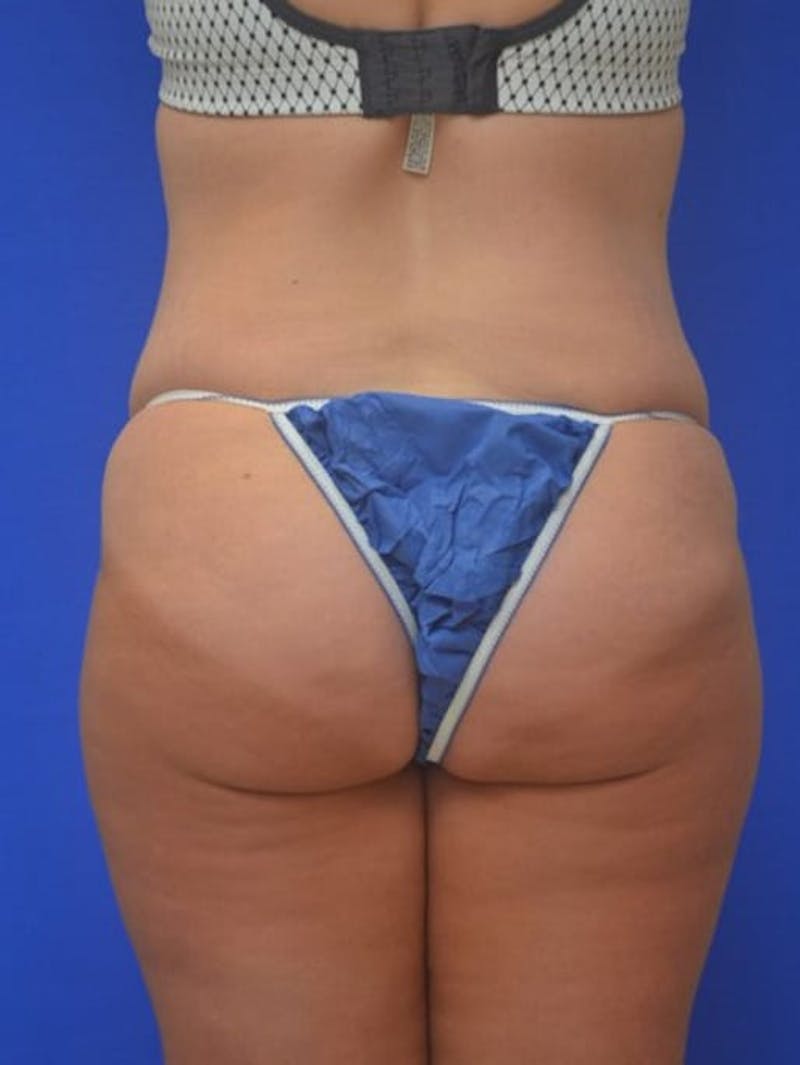 Tummy Tuck Before & After Gallery - Patient 378091 - Image 11
