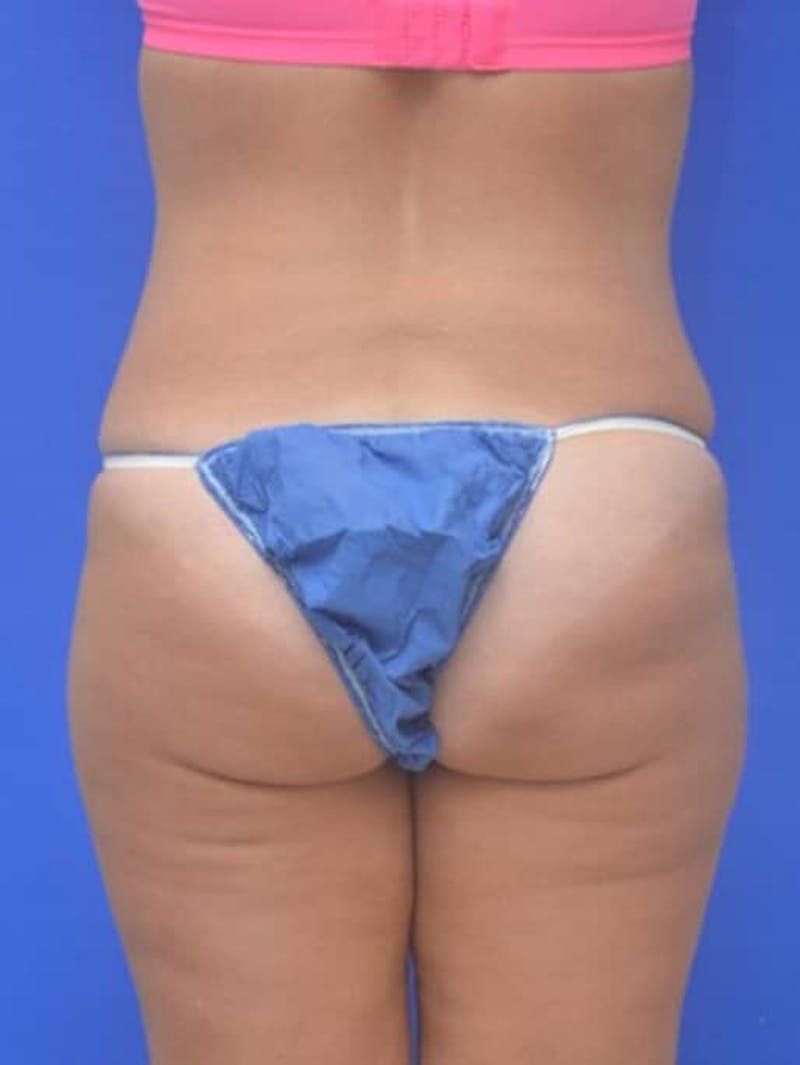 Tummy Tuck Before & After Gallery - Patient 378091 - Image 12
