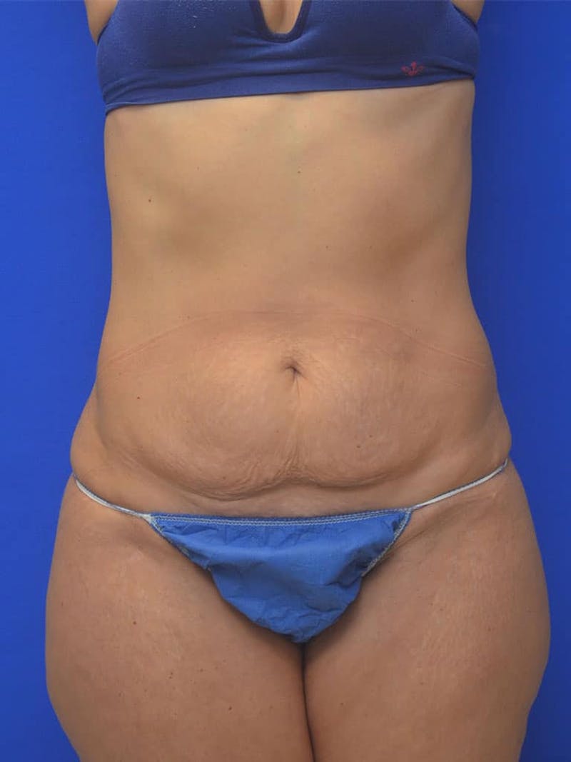Tummy Tuck Before & After Gallery - Patient 542596 - Image 1