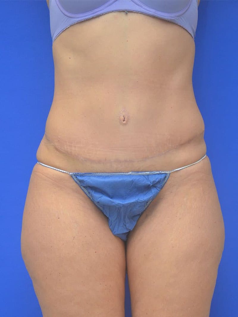 Tummy Tuck Before & After Gallery - Patient 542596 - Image 2