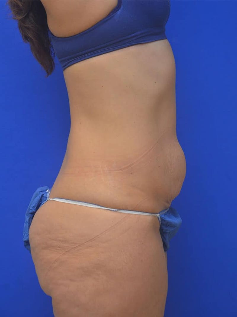 Tummy Tuck Before & After Gallery - Patient 542596 - Image 3