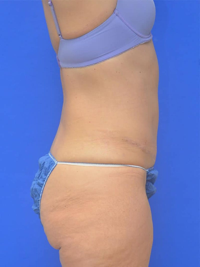 Tummy Tuck Before & After Gallery - Patient 542596 - Image 4