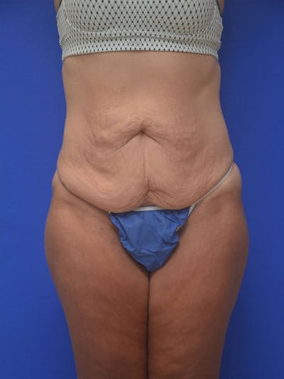Tummy Tuck Before & After Gallery - Patient 413798 - Image 1