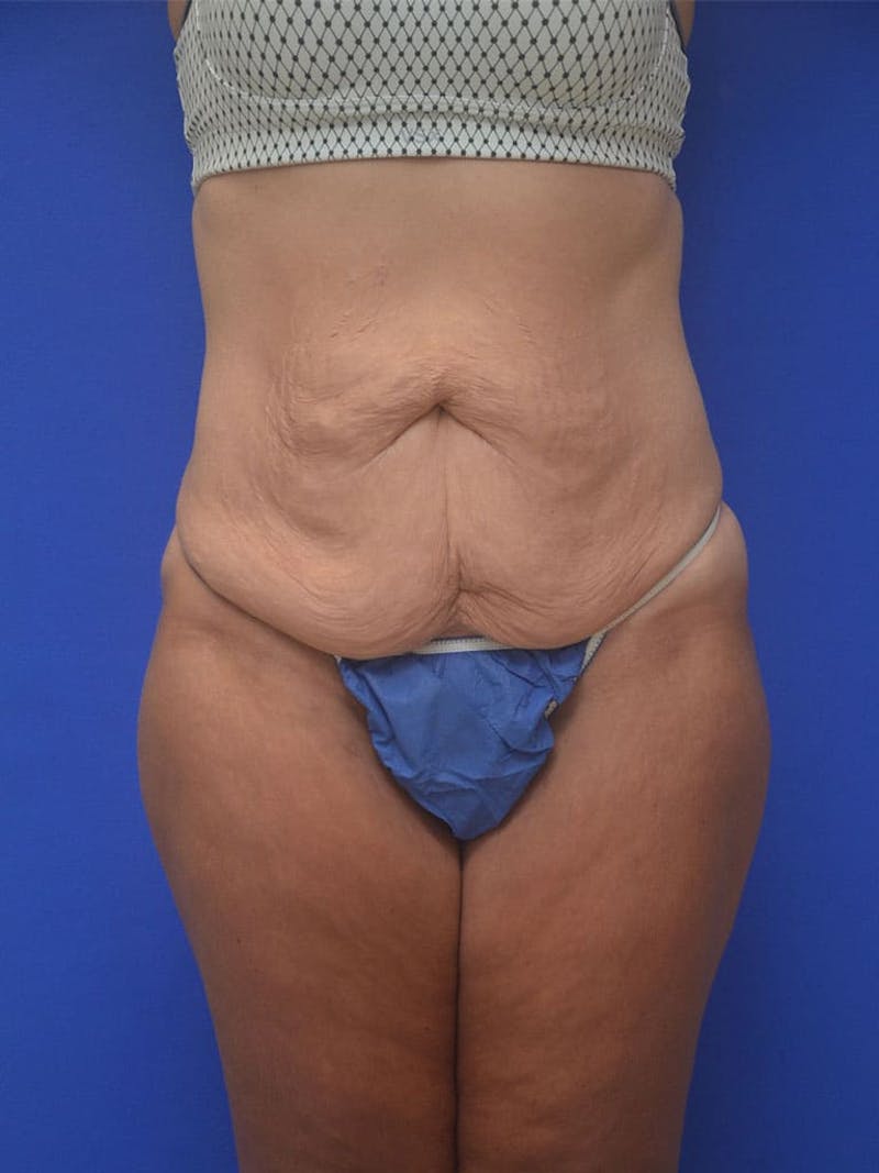 Tummy Tuck Before & After Gallery - Patient 413798 - Image 1