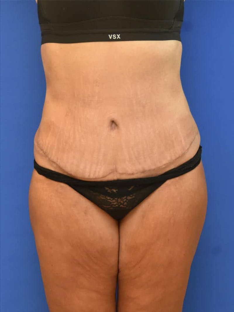 Tummy Tuck Before & After Gallery - Patient 413798 - Image 2