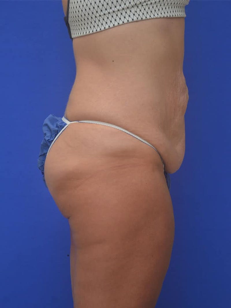 Tummy Tuck Before & After Gallery - Patient 413798 - Image 3