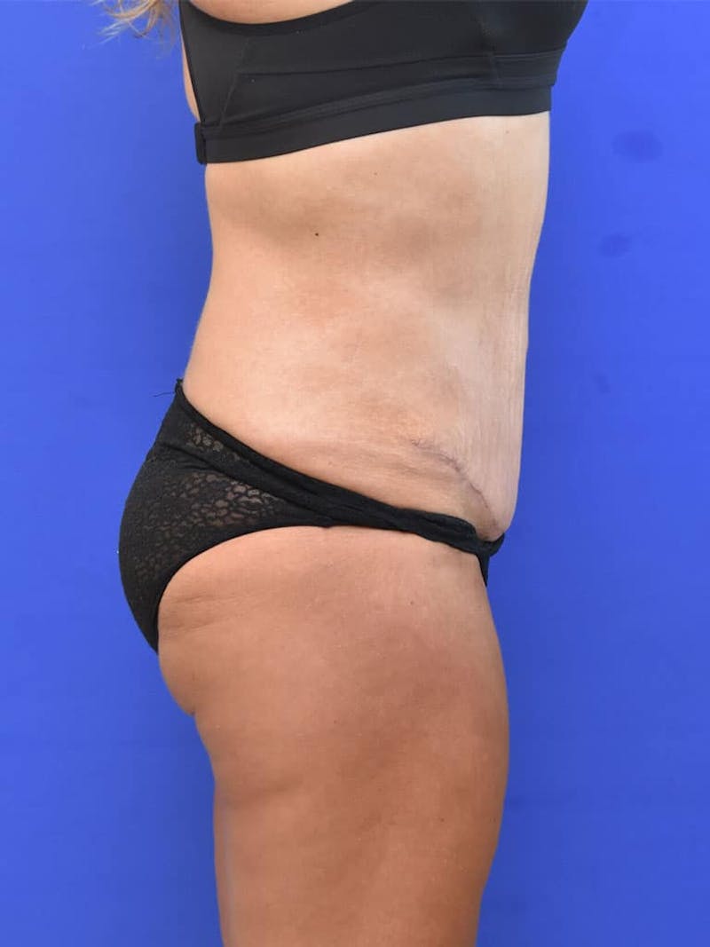 Tummy Tuck Before & After Gallery - Patient 413798 - Image 4